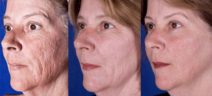 النتيجة بعد عملية تجديد بشرة الوجه بالليزر
